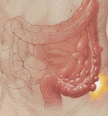 Enfermedad diverticular.jpeg