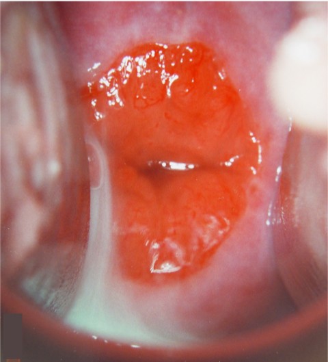 Archivo:Afecciones benignas del útero.jpg