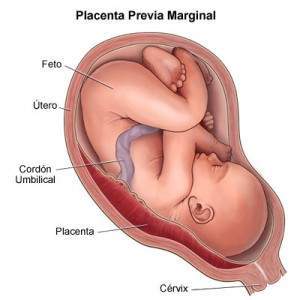Placenta-previa-2-300x300.jpg