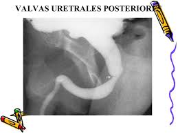 Valvulauretraposterior.jpg