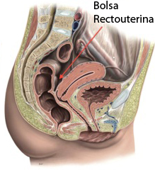 Bolsa rectouterina.jpg