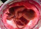 Cordon umbilical bebe.jpg