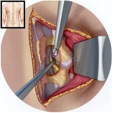 Foto de Biopsia de pulmón a cielo abierto.JPG