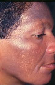 Image ocronosis-2.jpeg