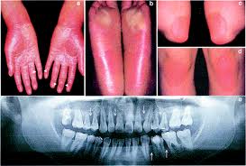 Síndrome de Papillon Lefévre.jpg