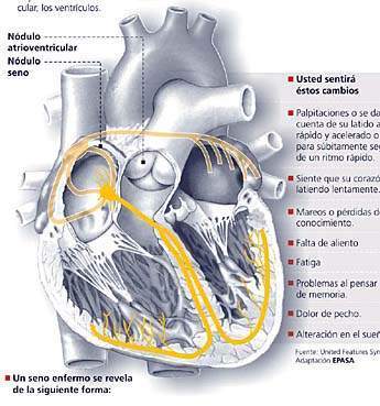 Archivo:Síndrome del seno enfermo.jpg