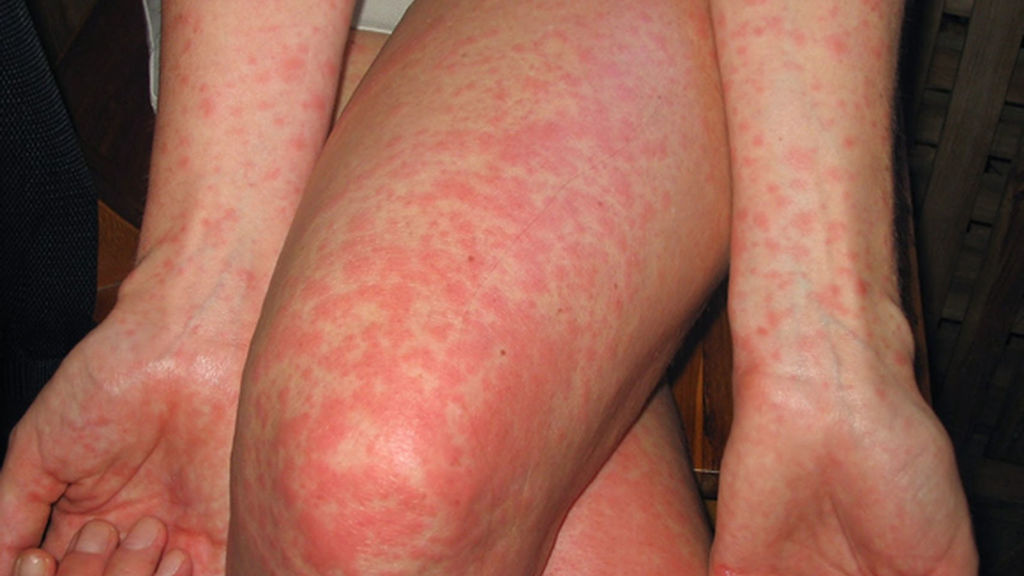 presentar Similar Ciencias Alergias de la piel - EcuRed