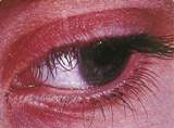 SOA-Pediculosis-pubis-eyes.jpg