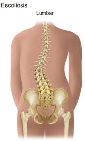 Escoliosis.jpg