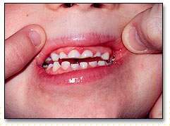 Bruxismo infantil.jpg