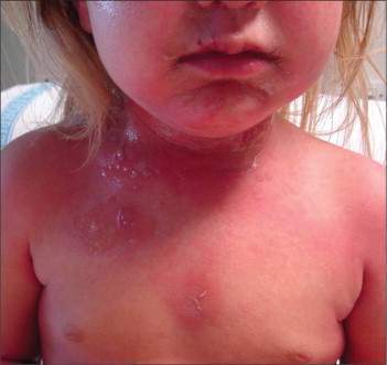 Archivo:Sind escald estafil 3.jpg