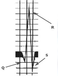 Alter QRS en altura.jpeg