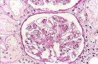 Glomerulonefritis.jpeg
