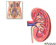 Insuficiencia renal.jpg