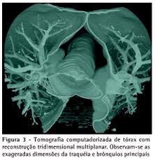 Traquepulmonar.jpg