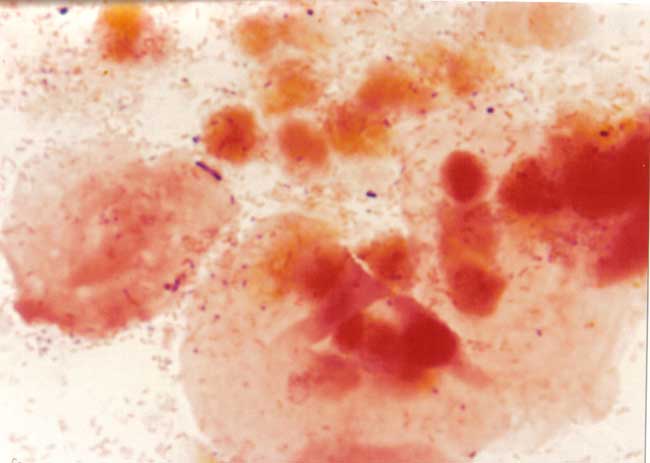 Vaginosis bacteriana EcuRed