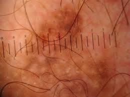 Dermatoscopia 1.jpg