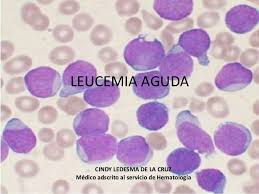 Leucemia aguda.jpg