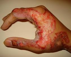 Archivo:Quemadura por radiación 1.jpeg