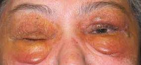 Amiloidosis primaria.jpg