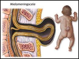 Mielomeningoceleotra.jpeg