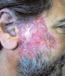 Foliculutis depilante.JPG