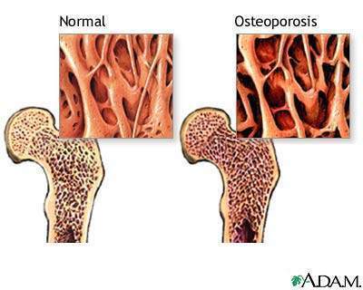 Archivo:Osteoporosis6123123.jpg