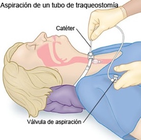 Tecnica de aspiracion.jpg