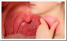 Larigitis cronica.jpg