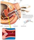 Prueba de Papanicolau.jpeg