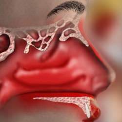 Rinitis-cronica .jpg