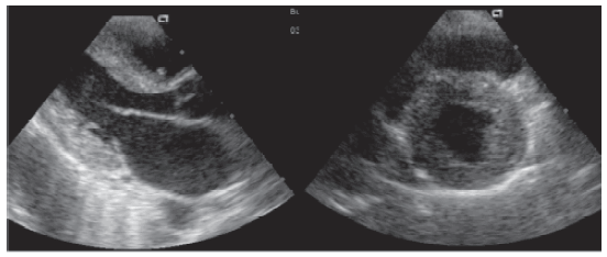 Archivo:Amiloidosis cardíaca.gif