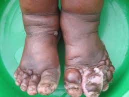Podoconiosis.jpg