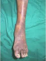 Sindrome de Insuficiencia Arterial.jpeg