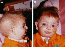 Archivo:Anemia de diamond-blackfan.jpg