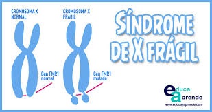 Archivo:Sindrome X Fragil.jpg