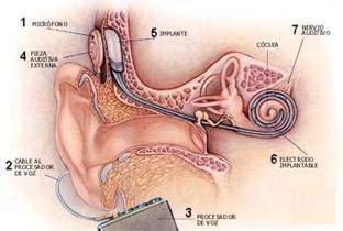Hipoacusia profunda aislada: Se define como la disminución de la percepción auditiva.