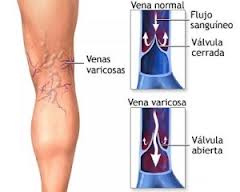 Insuficiencia venosa.jpg