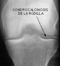 condrocalcinosis