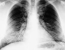 Protepulmonar.jpg