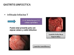 Gastritis linfocítica (GL).jpg