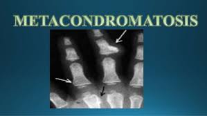 Metacondromatosis.jpg
