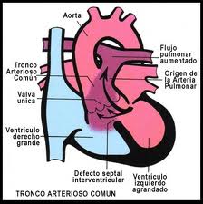 Persistencia del tronco arterioso índice.jpeg