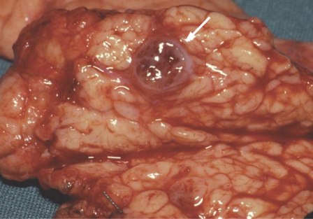 Archivo:Tumores del páncreas.jpg