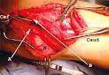 Arteria poplítea Brayan.jpg