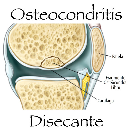 Archivo:Osteocondritís Disecante.jpg