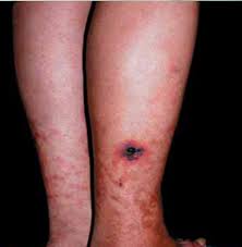 Panartenitis nodosa.jpg