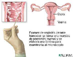 Vaginitisatrófica.jpg‎‎