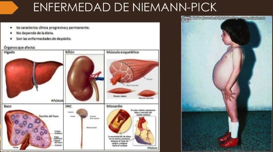 Enfermedad de Niemann-Pick: daño neurológico provocado por lípidos – FEMEXER
