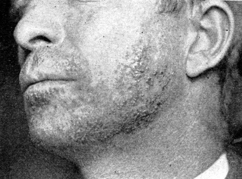 Archivo:La Sicosis de la barba .jpg